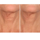 Neck Sio Necklift Reusable Wrinkle Smoothing Patches